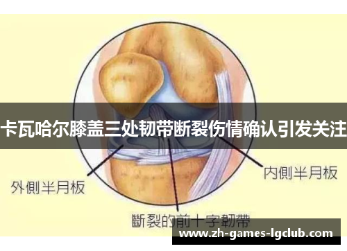 卡瓦哈尔膝盖三处韧带断裂伤情确认引发关注 卡瓦哈尔膝盖三处韧带断裂伤情确认引发关注